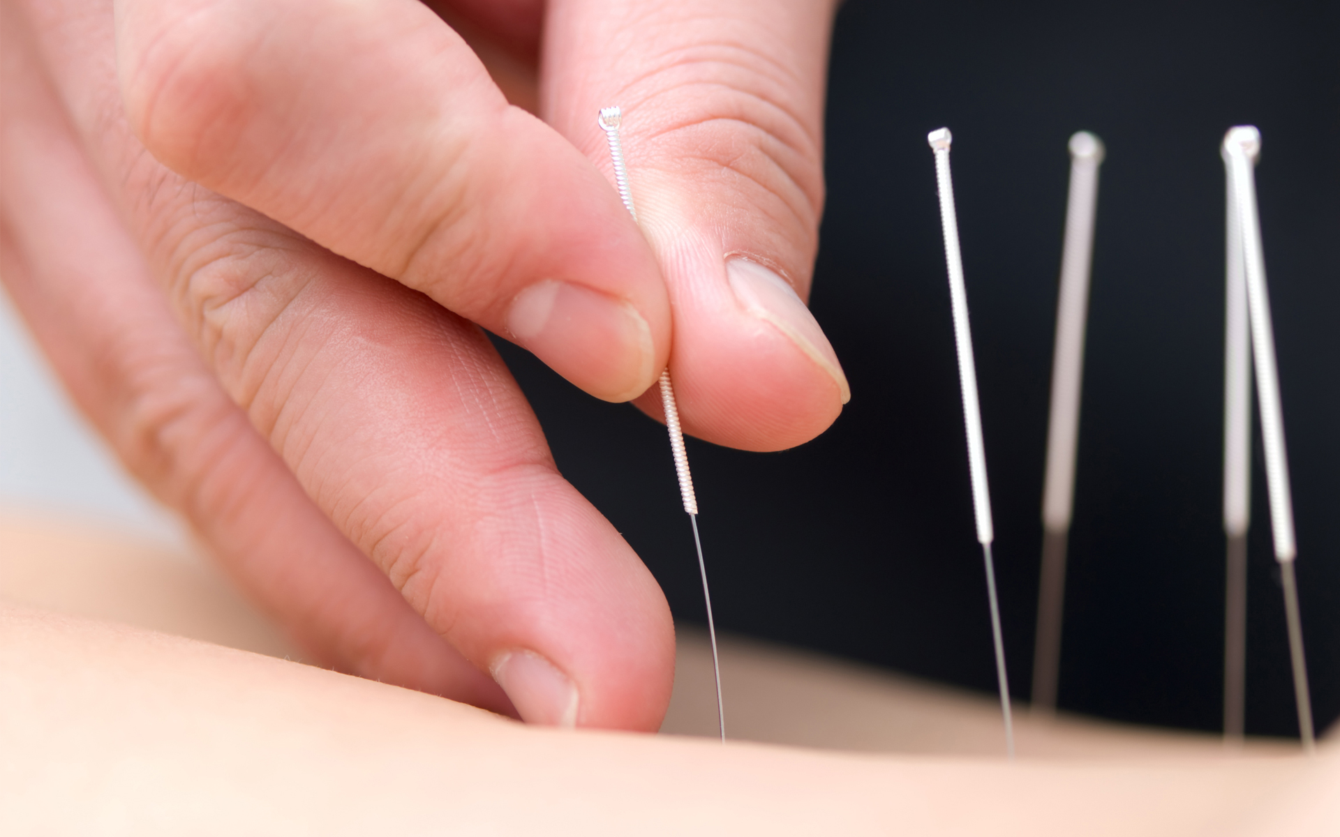 Wie funktioniert Akupunktur in der Traditionellen Chinesischen Medizin (TCM)